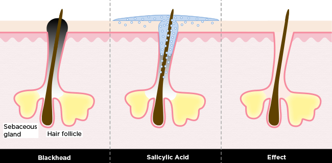 Salicylic Acid Dr. Jetske Ultee